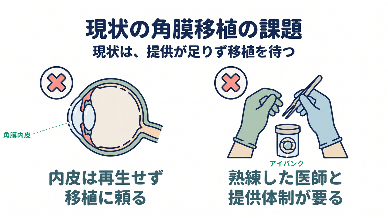 現状の角膜移植の課題｜現状は、提供が足りず移植を待つ｜内皮は再生せず移植に頼る／熟練した医師と提供体制が要る
