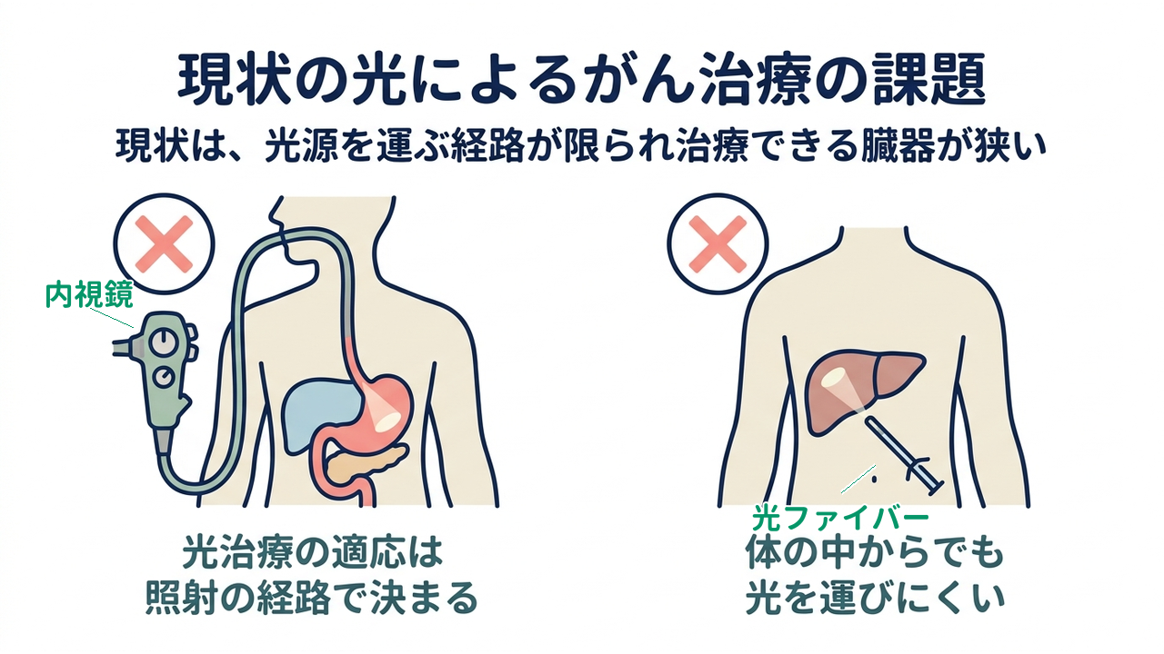 現状の光によるがん治療の課題｜現状は、光源を運ぶ経路が限られ治療できる臓器が狭い｜光治療の適応は・照射の経路で決まる／体の中からでも・光を運びにくい