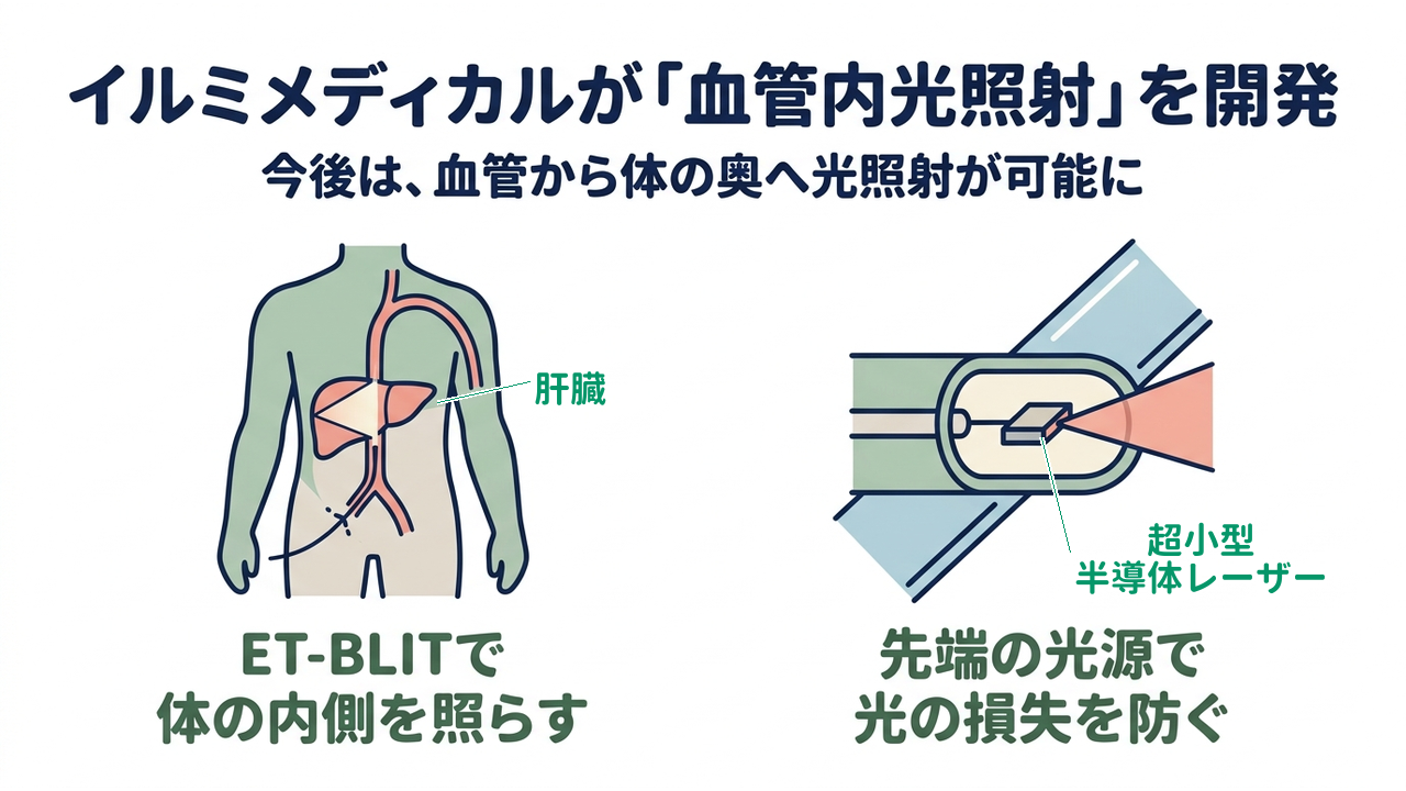 イルミメディカルが「血管内光照射」を開発｜今後は、血管から体の奥へ光照射が可能に｜ET-BLITで・体の内側を照らす／先端の光源で・光の損失を防ぐ