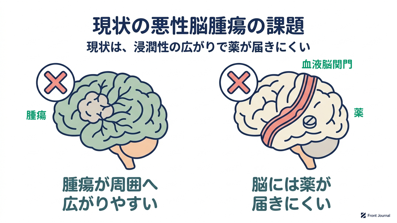 現状の悪性脳腫瘍の課題｜現状は、浸潤性の広がりで薬が届きにくい／腫瘍が周囲へ広がりやすい／脳には薬が届きにくい
