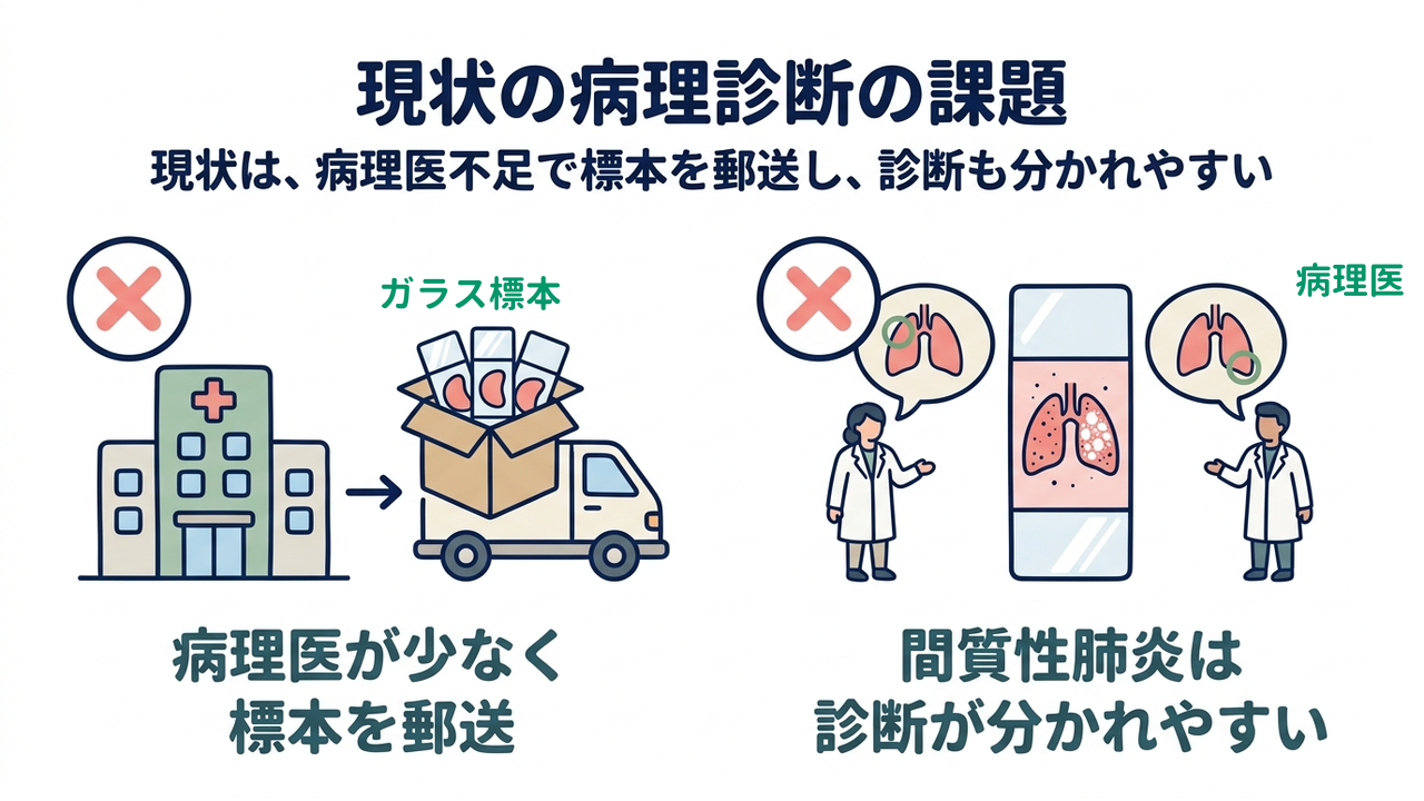 現状の病理診断の課題｜現状は、病理医不足で標本を郵送し、診断も分かれやすい｜病理医が少なく・標本を郵送／間質性肺炎は・診断が分かれやすい