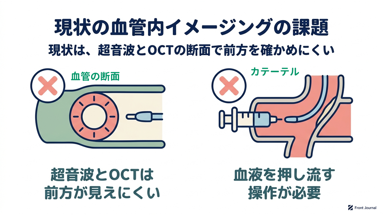 現状の血管内イメージングの課題|現状は、超音波とOCTの断面で前方を確かめにくい|超音波とOCTは・前方が見えにくい/血液を押し流す・操作が必要