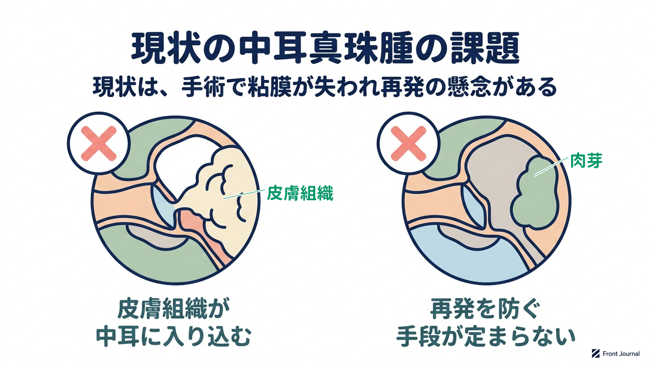 現状の中耳真珠腫の課題|皮膚組織が中耳に入り込む/再発を防ぐ手段が定まらない