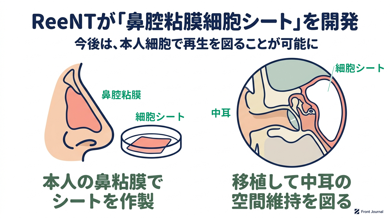 ReeNTが「鼻腔粘膜細胞シート」を開発|本人の鼻粘膜でシートを作製/移植して中耳の空間維持を図る