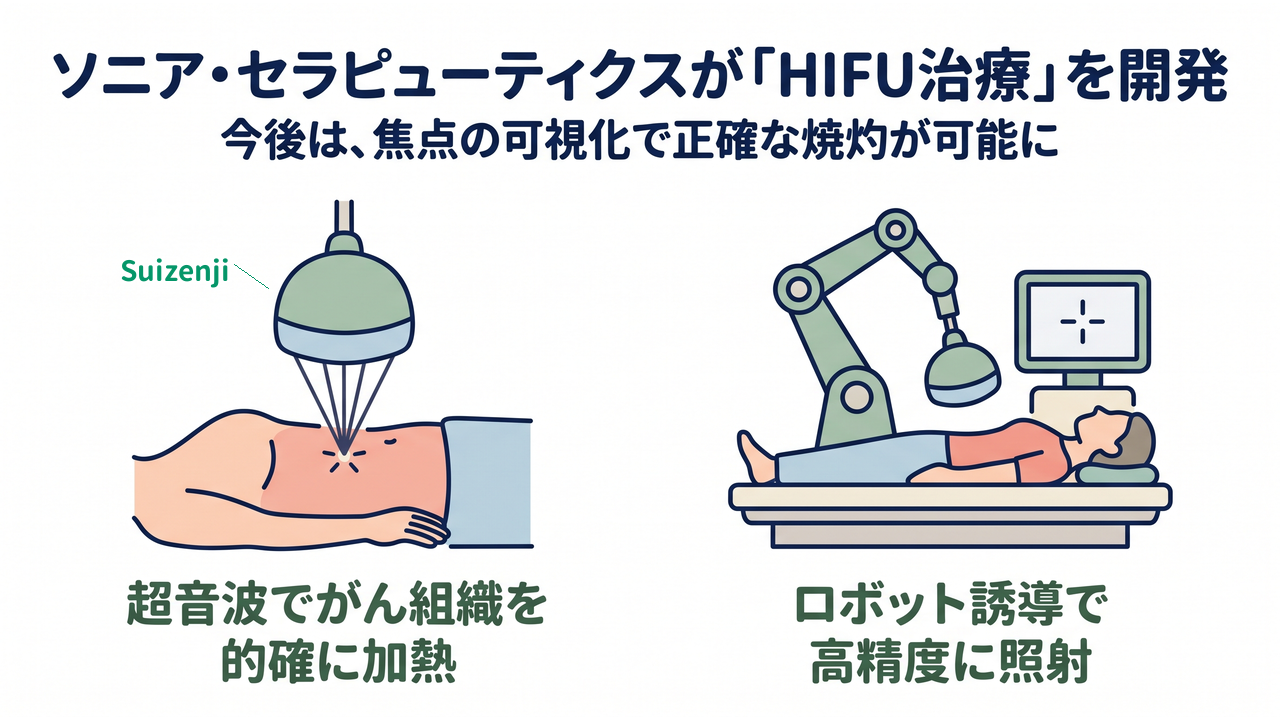 ソニア・セラピューティクスが「HIFU治療」を開発｜今後は、焦点の可視化で正確な焼灼が可能に／超音波でがん組織を的確に加熱（装置名Suizenji）／ロボット誘導で高精度に照射