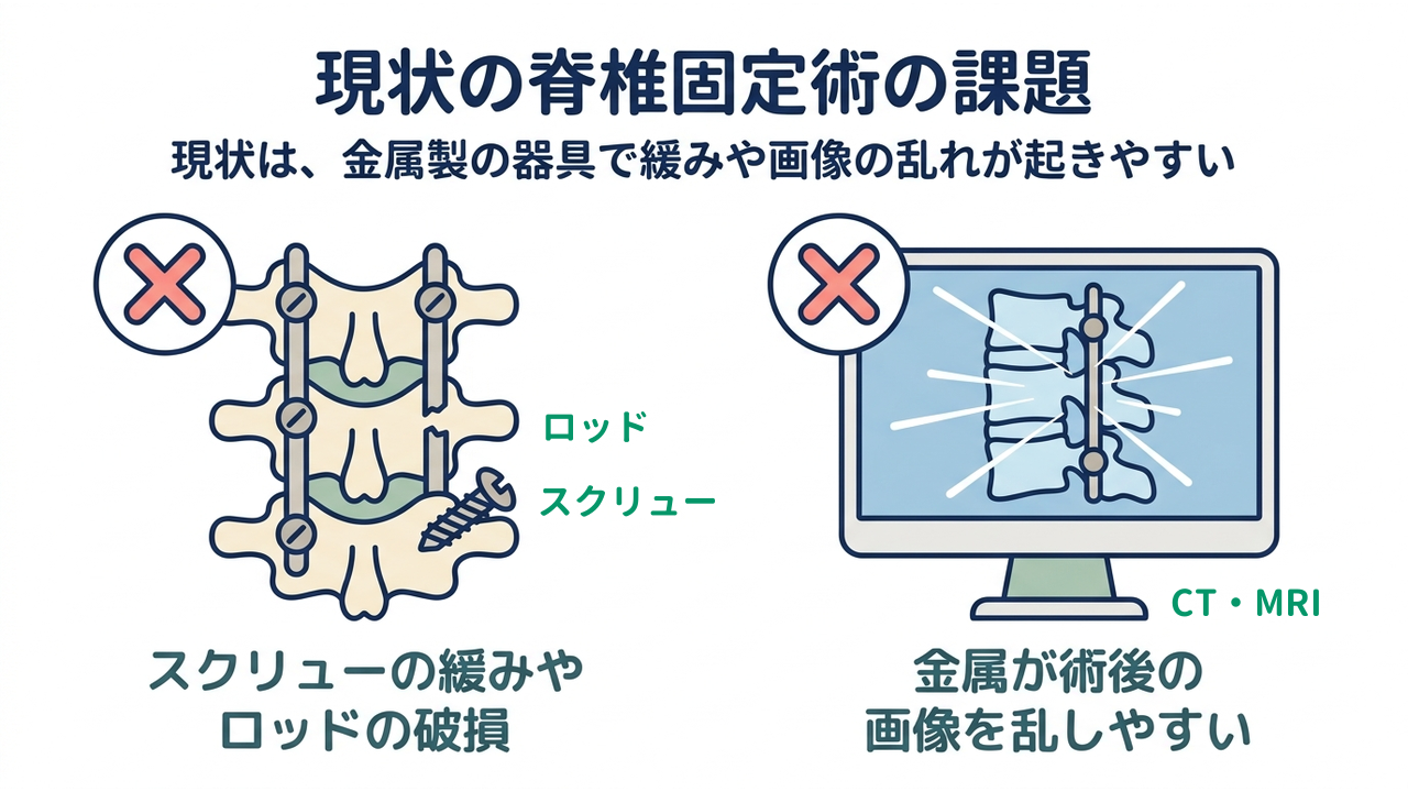 現状の脊椎固定術の課題｜現状は、金属製の器具で緩みや画像の乱れが起きやすい／スクリューの緩みやロッドの破損／金属が術後の画像を乱しやすい